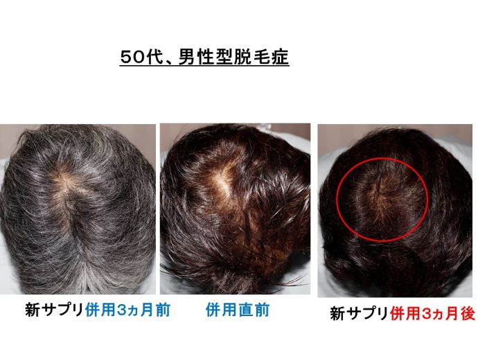 円形脱毛症　病院
